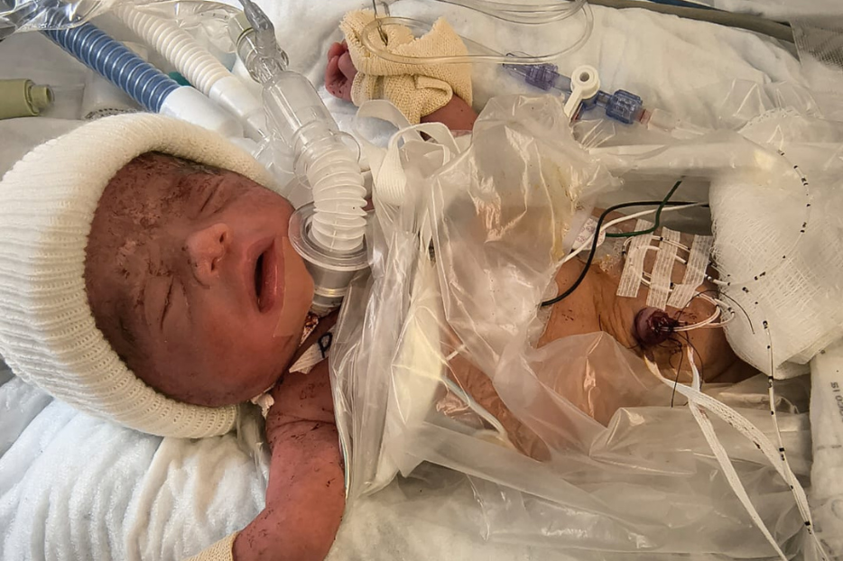 Meet the ‘Miracle Baby’ Born Twice in Florida