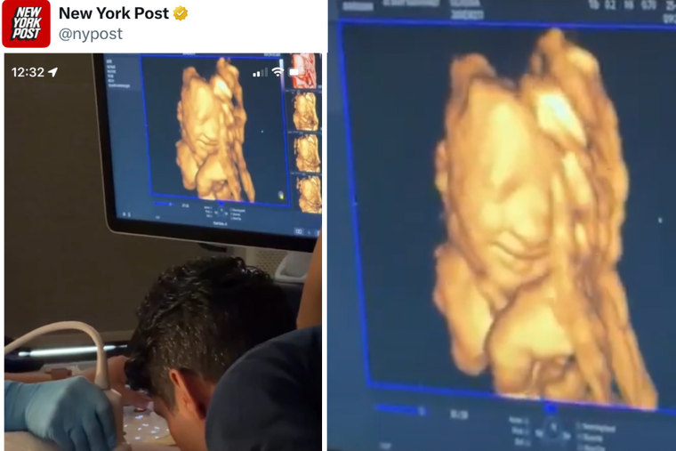 Caught on Camera: Ultrasound Captures Unborn Baby Smiling as Her Father Speaks