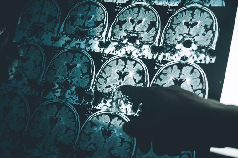 New FDA-Approved Blood Test Could Detect Alzheimer’s 5 to 10 Years Before Symptoms Appear